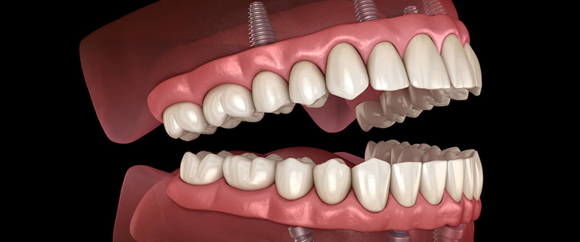Can I Brush and Floss My Teeth with All-on-4 Dental Implants?