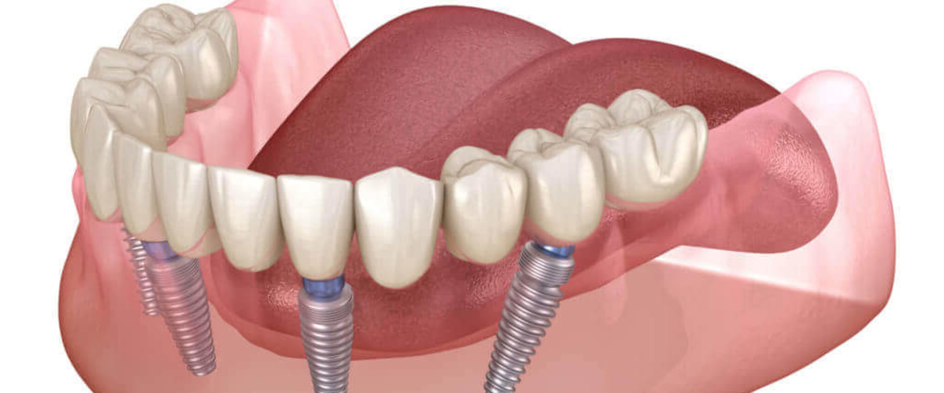 Can I Get a Full Set of Teeth with All-on-4 Dental Implants?