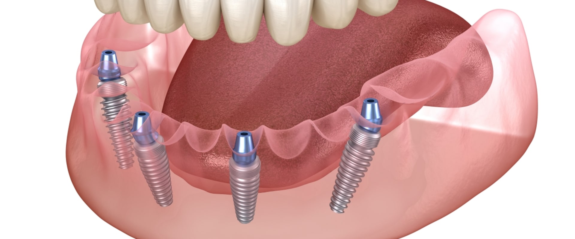 Who is a Good Candidate for All-on-4 Dental Implants?
