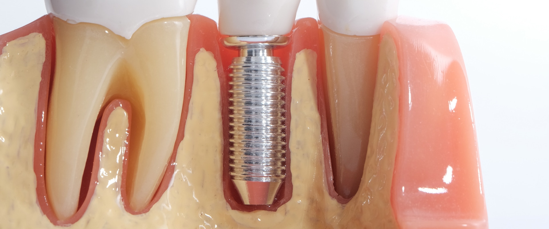How Long Do Dental Implants Last?