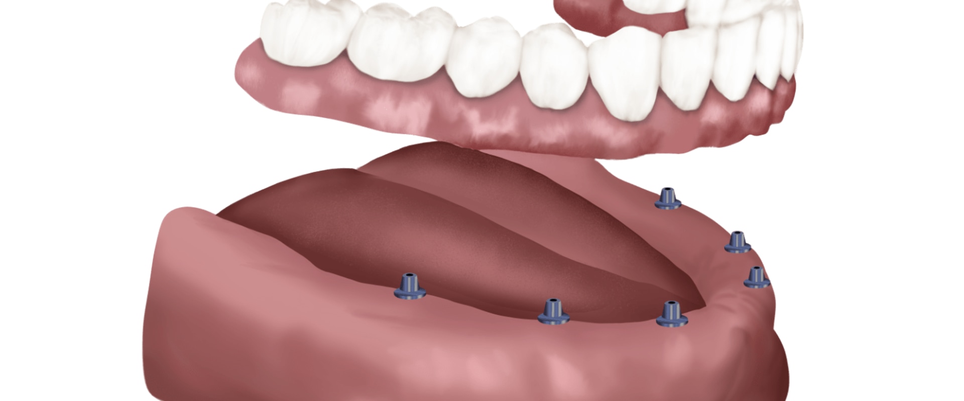 Are All-on-6 Dental Implants a Permanent Solution?