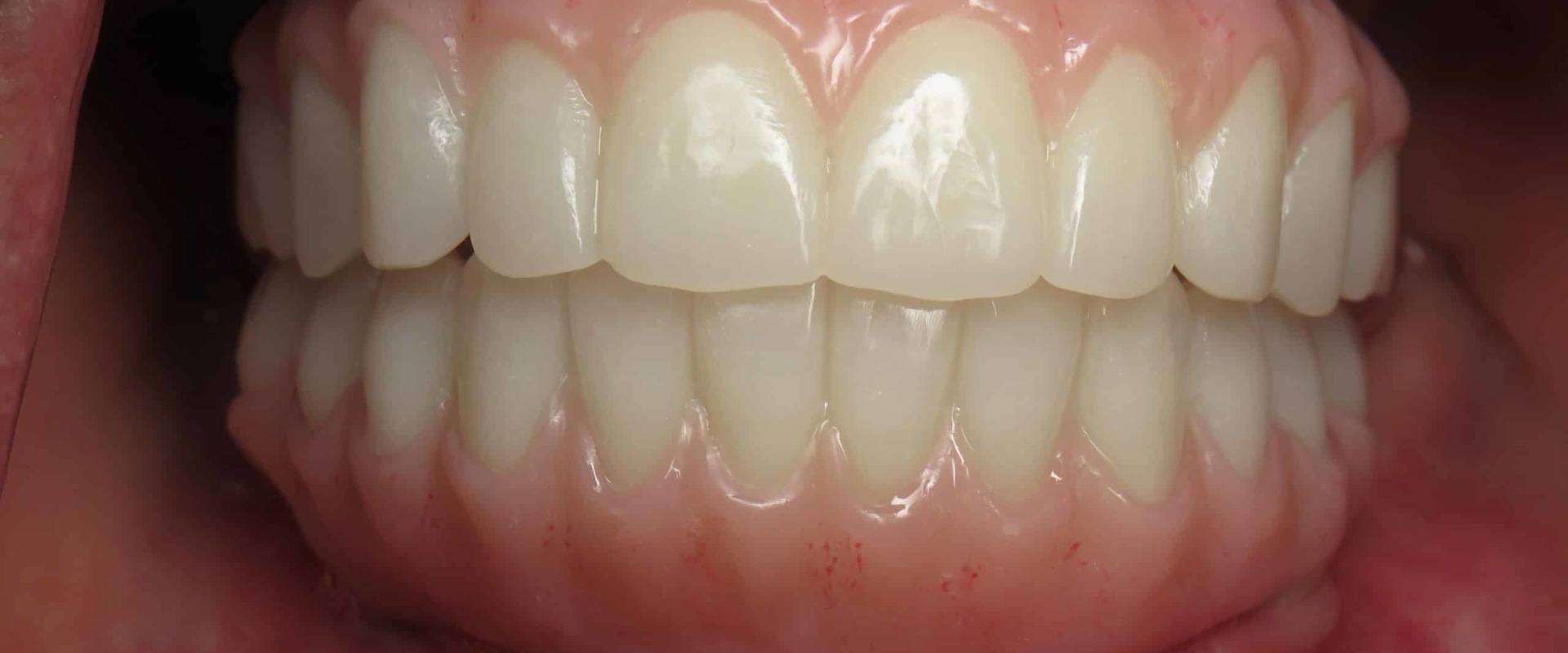 How Long Does it Take for Gums to Heal After All-on-4 Dental Implants?