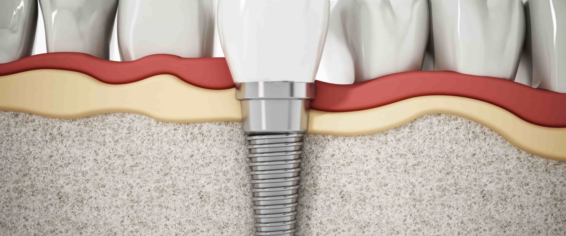 Do Dental Implants Ever Need to be Replaced?