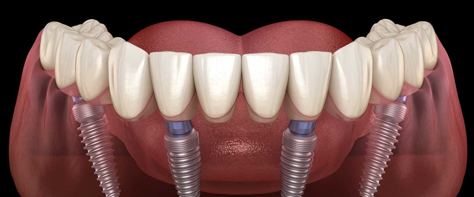 Will All-on-4 Dental Implants Affect Your Facial Appearance?