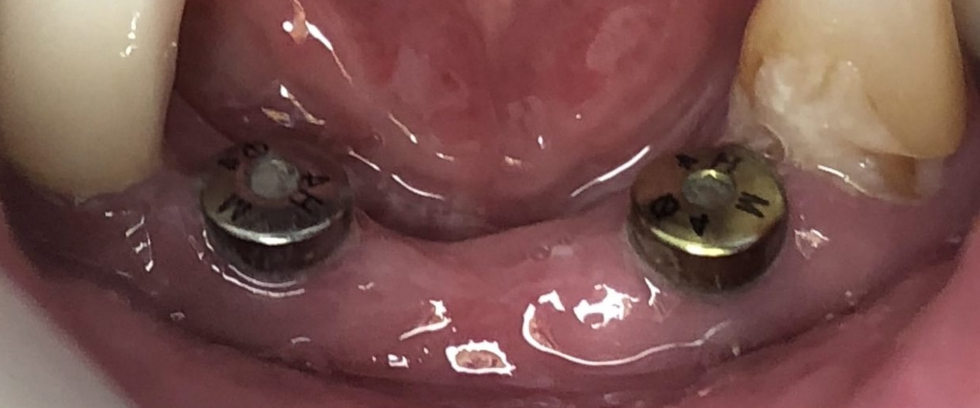 Can You Get Dental Implants on the Same Day as Tooth Extraction?