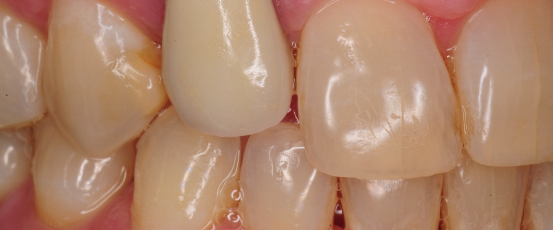 Dental Implant Infection: How Common Is It?