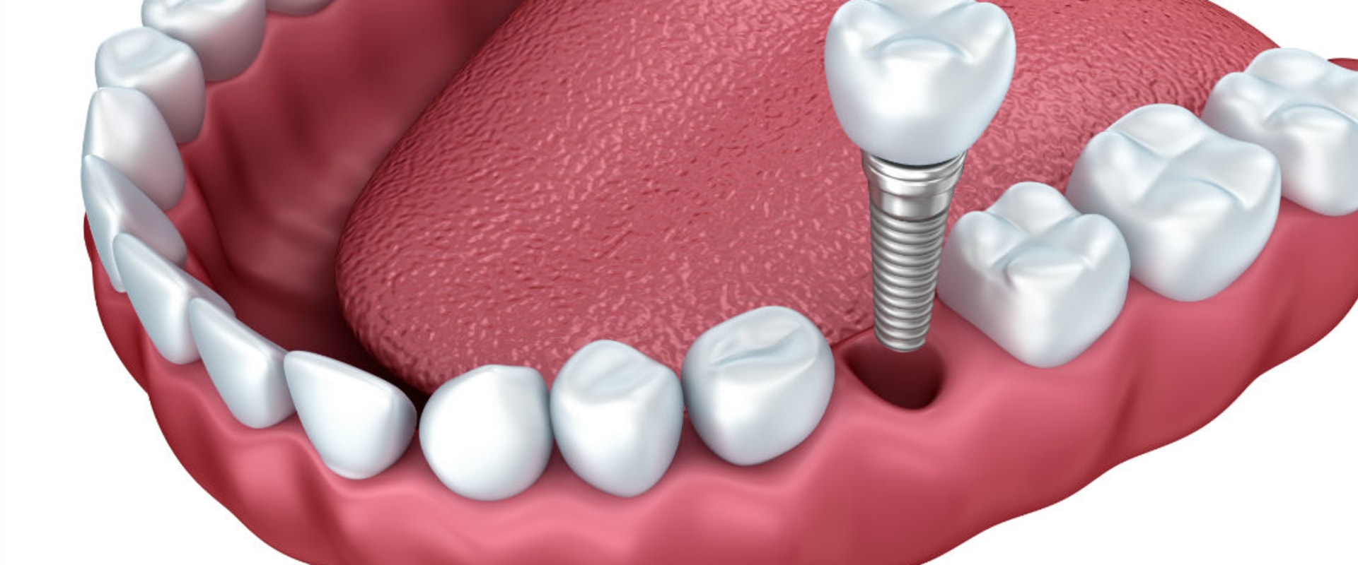 Are Dental Implants Permanently Attached?