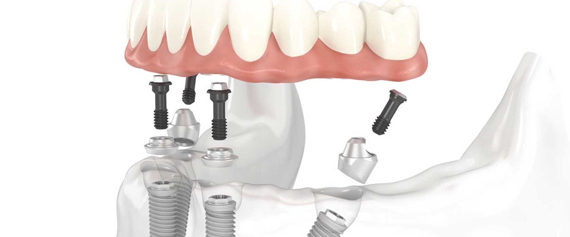 The Cost of All-on-4 Dental Implants in the UK: What You Need to Know