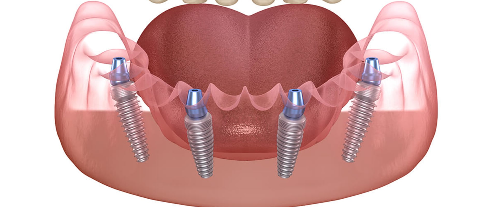 What are the Risks and Benefits of All-on-4 Dental Implants?