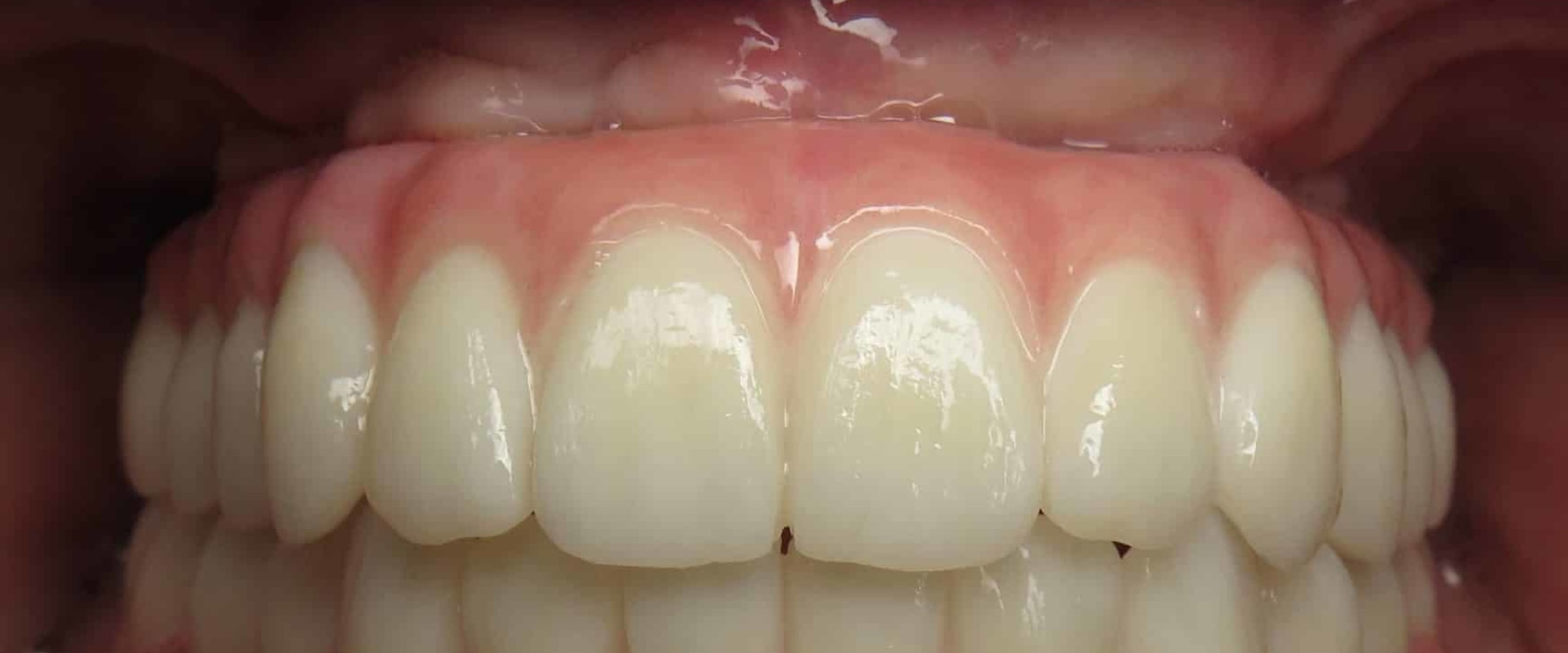 Can I Get All-on-4 Dental Implants If I Have Gum Disease?