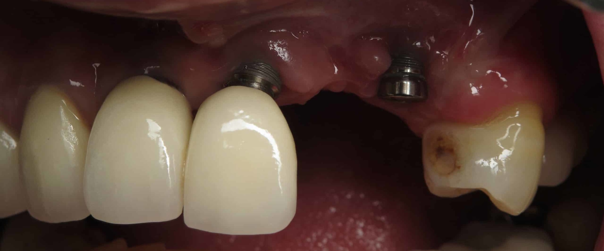 What to Do When a Dental Implant Fails