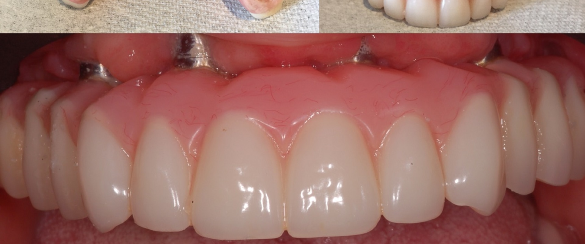 What Foods Should I Avoid After Getting All-on-4 Dental Implants?