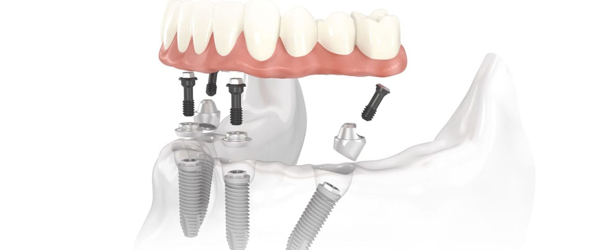 How Often Should You Visit the Dentist for All-on-4 Dental Implants?