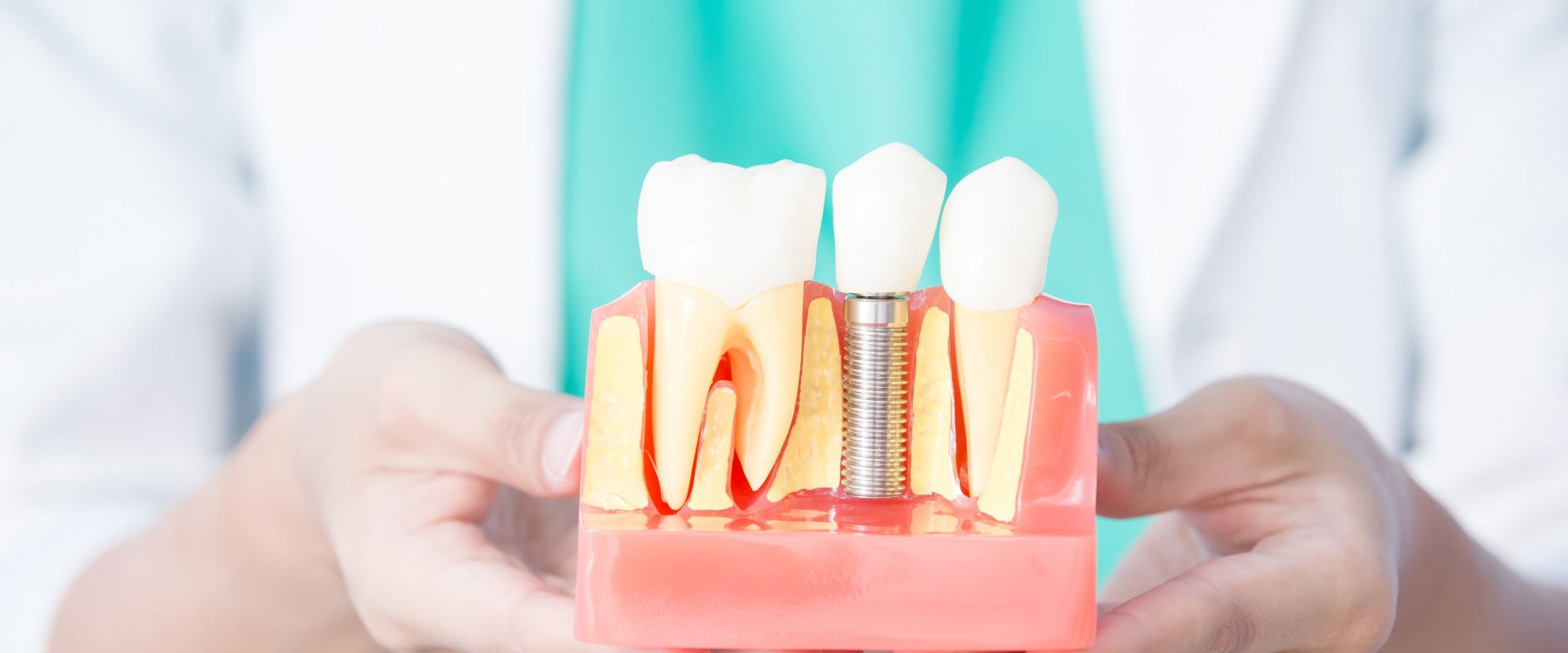 Everything You Need to Know About Dental Implants