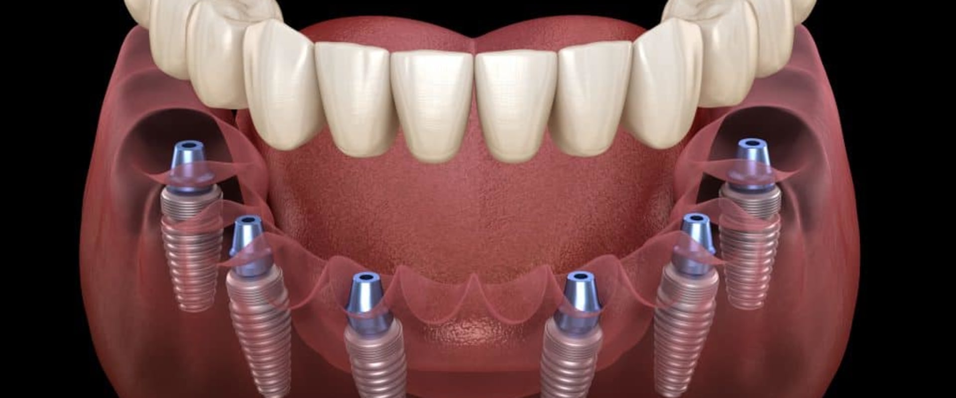 What is the Best Option for Dental Implants: All-on-4 or All-on-6?