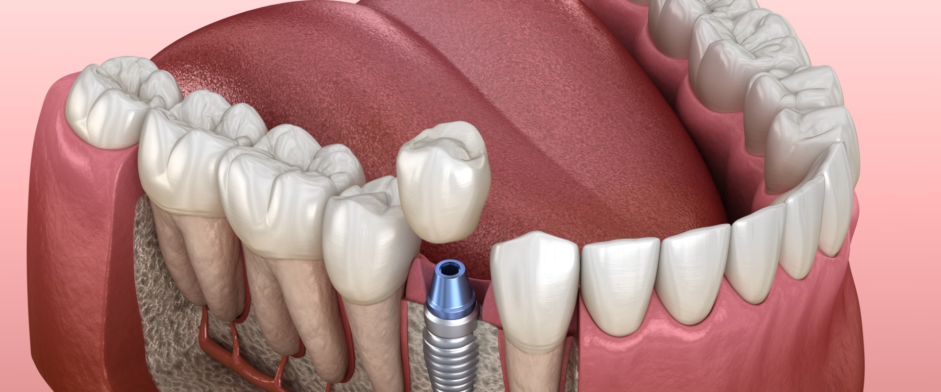Can I Get All-on-4 Dental Implants with a Weak Jawbone?