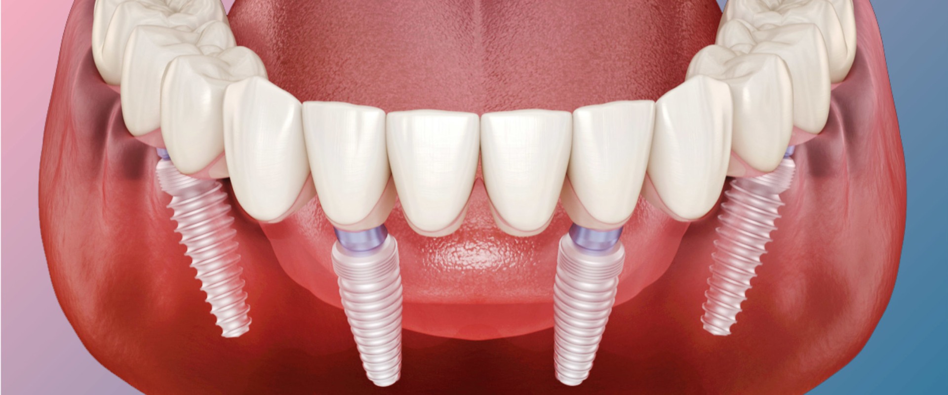 Which is Better: All-on-4 or All-on-6 Dental Implants?