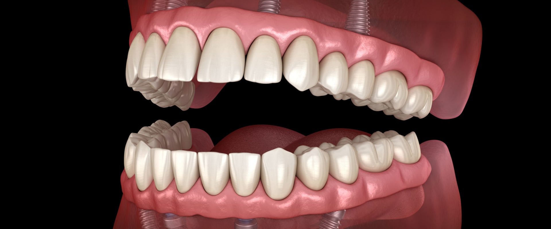 How Long Does it Take to Get All-on-4 Dental Implants?
