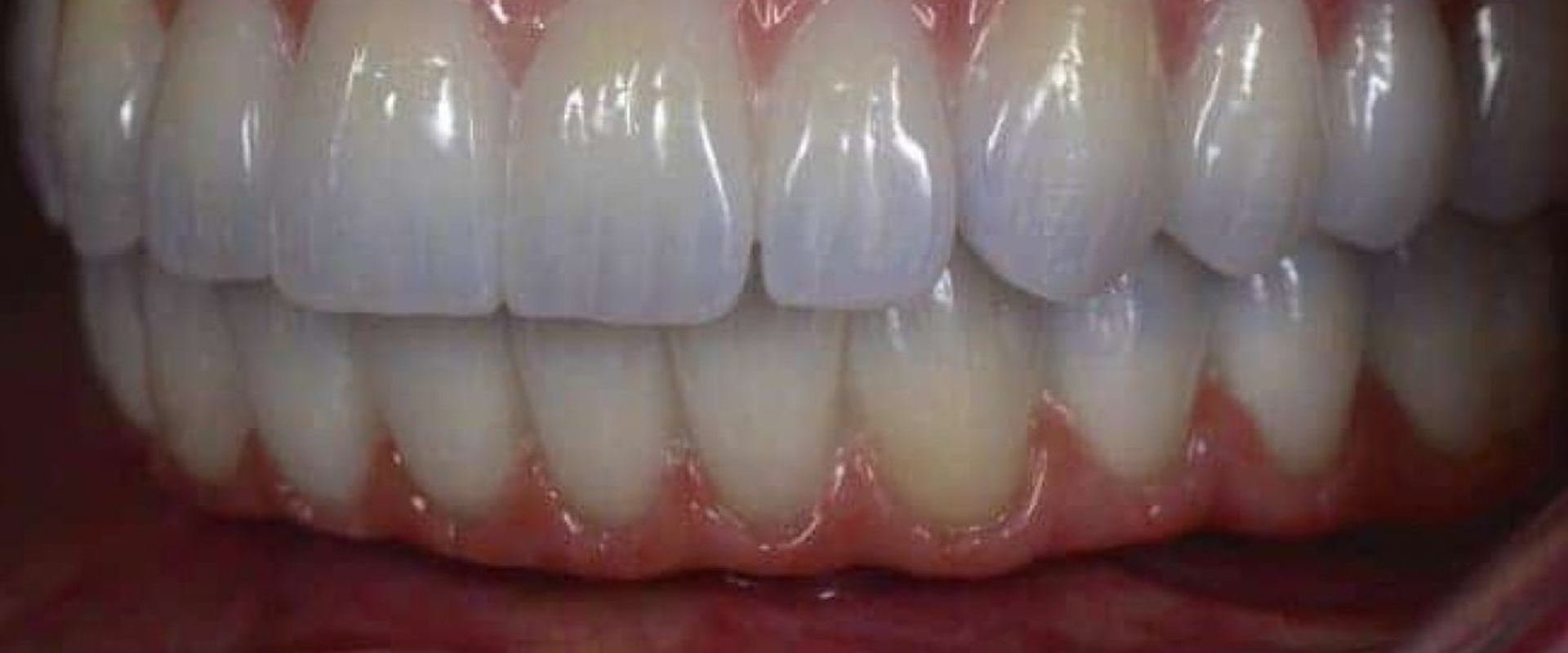 Are All-on-4 Dental Implants Painful? An Expert's Perspective