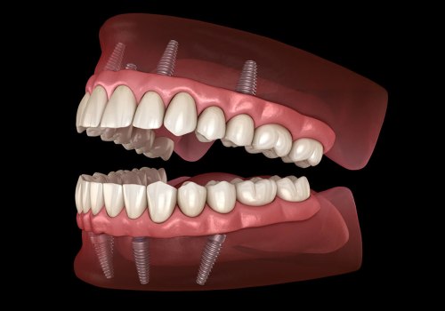 Can I Brush and Floss My Teeth with All-on-4 Dental Implants?