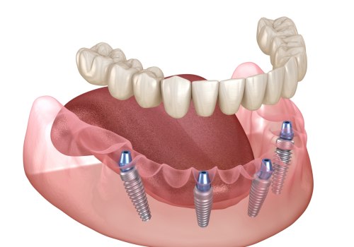 Who is a Good Candidate for All-on-4 Dental Implants?