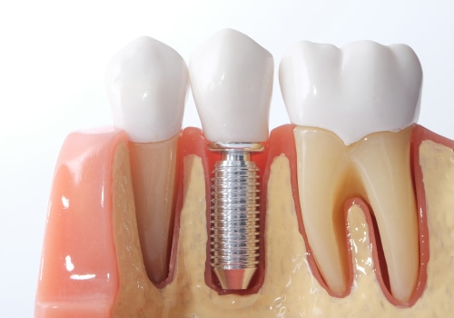 How Long Do Dental Implants Last?