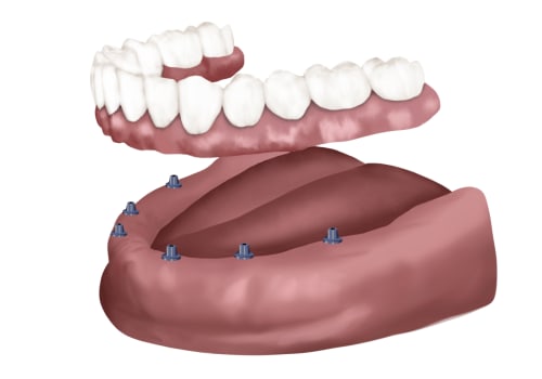 Are All-on-6 Dental Implants a Permanent Solution?