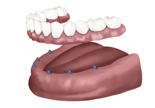 Are All-on-6 Dental Implants a Permanent Solution?