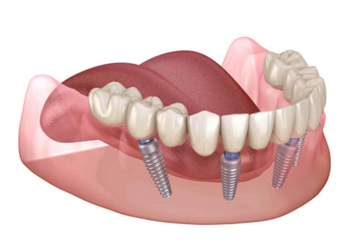 Can I Eat Normally with All-on-4 Dental Implants?