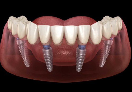 The Benefits of All-on-4 Dental Implants