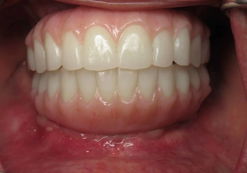How Long Does it Take for Gums to Heal After All-on-4 Dental Implants?