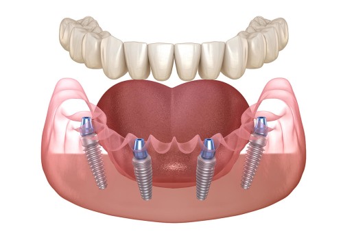 What Are the Risks of All-on-4 Dental Implants?