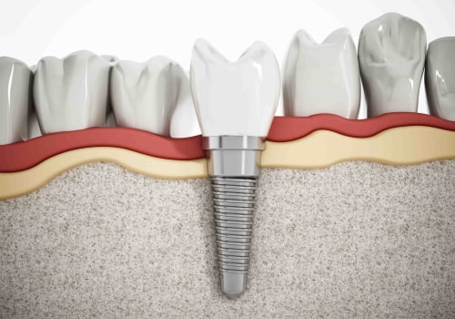 Do Dental Implants Ever Need to be Replaced?