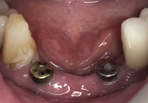 Can You Get Dental Implants on the Same Day as Tooth Extraction?