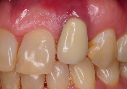 Dental Implant Infection: How Common Is It?