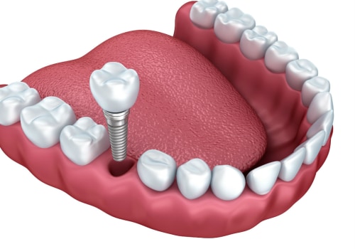 Are Dental Implants Permanently Attached?