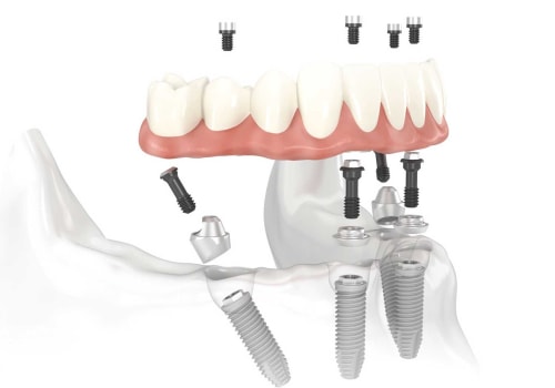 The Cost of All-on-4 Dental Implants in the UK: What You Need to Know