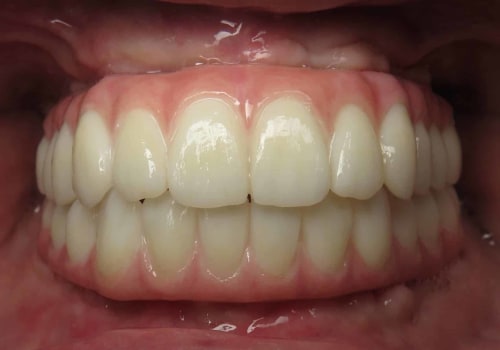 Can I Get All-on-4 Dental Implants If I Have Gum Disease?
