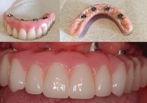 What Foods Should I Avoid After Getting All-on-4 Dental Implants?
