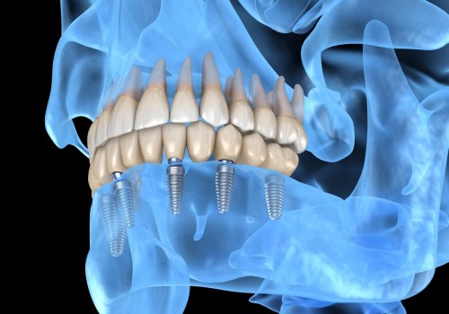 Can Dental Implants Last a Lifetime?