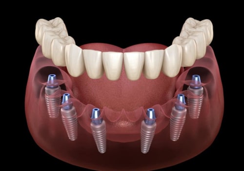 How Long Do All-on-6 Dental Implants Last?
