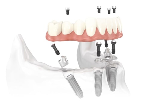 How Often Should You Visit the Dentist for All-on-4 Dental Implants?