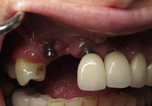 How Long Does it Take for a Dental Implant to Fail?