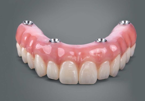 Get a New Smile with All-on-4 Dental Implants