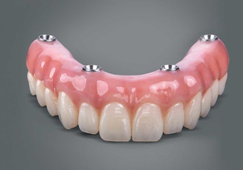 Which is Better: All-on-4 or All-on-6 Dental Implants?