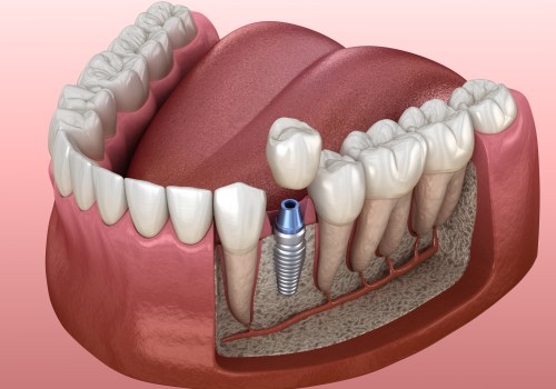 Can I Get All-on-4 Dental Implants with a Weak Jawbone?