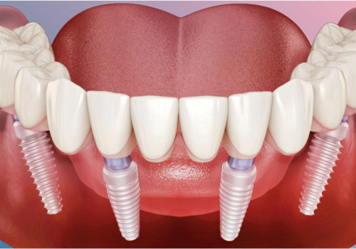 Which is Better: All-on-4 or All-on-6 Dental Implants?