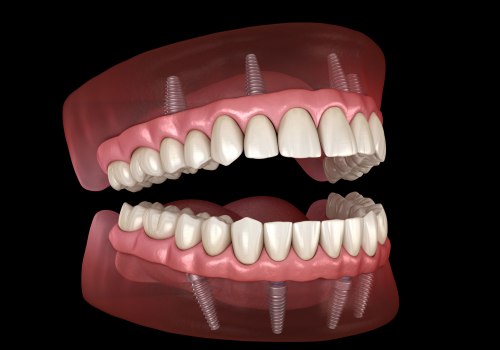 How Long Does it Take to Get All-on-4 Dental Implants?