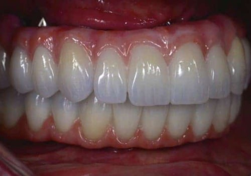 Are All-on-4 Dental Implants Painful? An Expert's Perspective